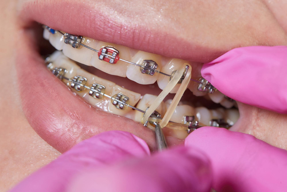 (P) Sfaturi pentru îngrijirea corectă a aparatului dentar