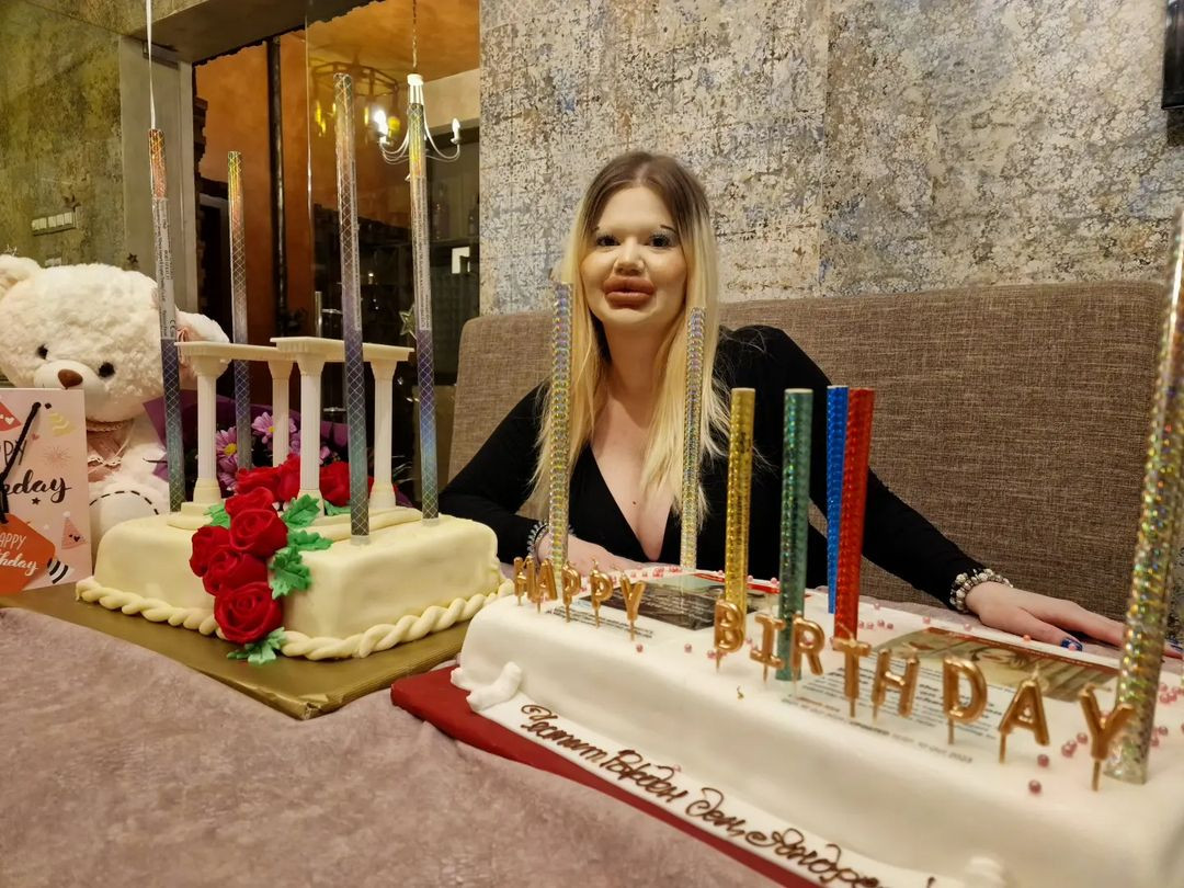 De ce a fost nevoită femeia cu cele mai mari buze din lume să-și injecteze și nasul