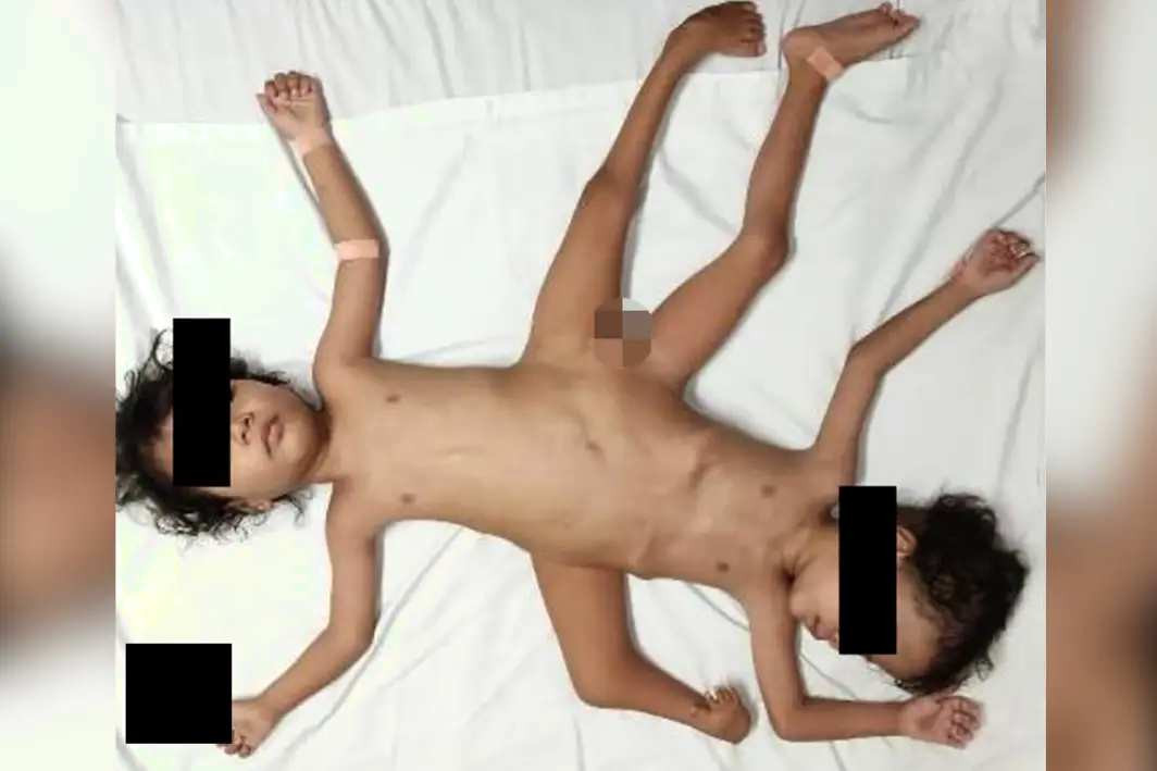 Gemenii „păianjen” cu trei picioare, patru brațe și un singur organ genital. Caz extrem de rar documentat de cercetători