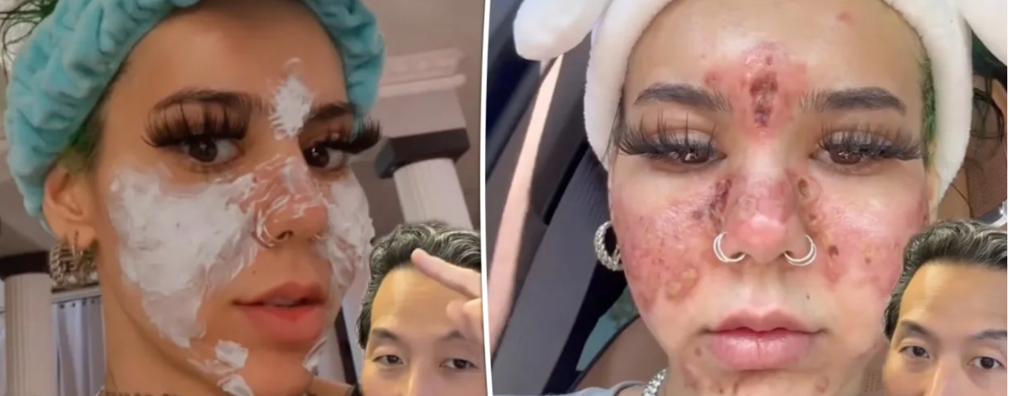 Ce se întâmplă cu faţa ta dacă foloseşti produse cosmetice expirate. „Pielea ei a început să ardă”