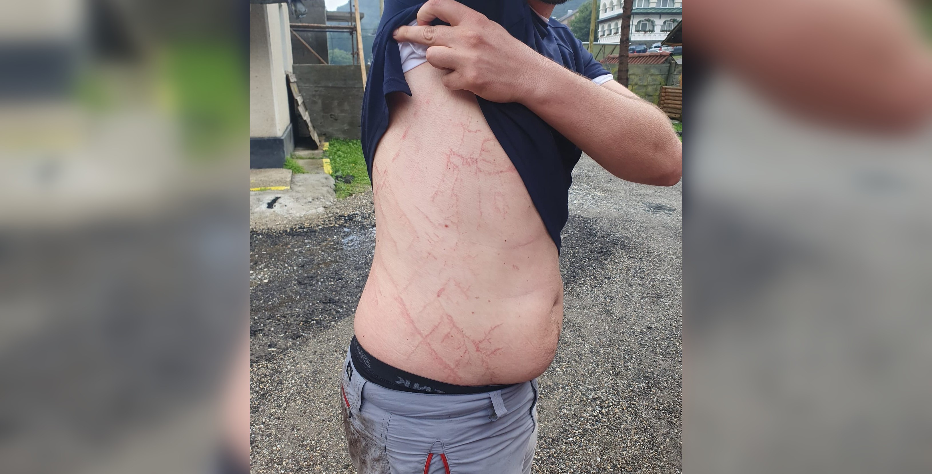 Semnele lăsate pe corpul unui bărbat de un trăsnet care a lovit lângă el. Avertismentul salvamontiștilor | FOTO