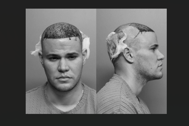 Un bărbat căruia îi curgea sânge din cap după un transplant de păr a fost arestat pentru că a refuzat să coboare din avion