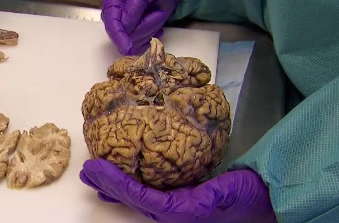 Tot mai multe fragmente de plastic se infiltrează în creierul uman. Ce se întâmplă în inimă, plămâni și ficat