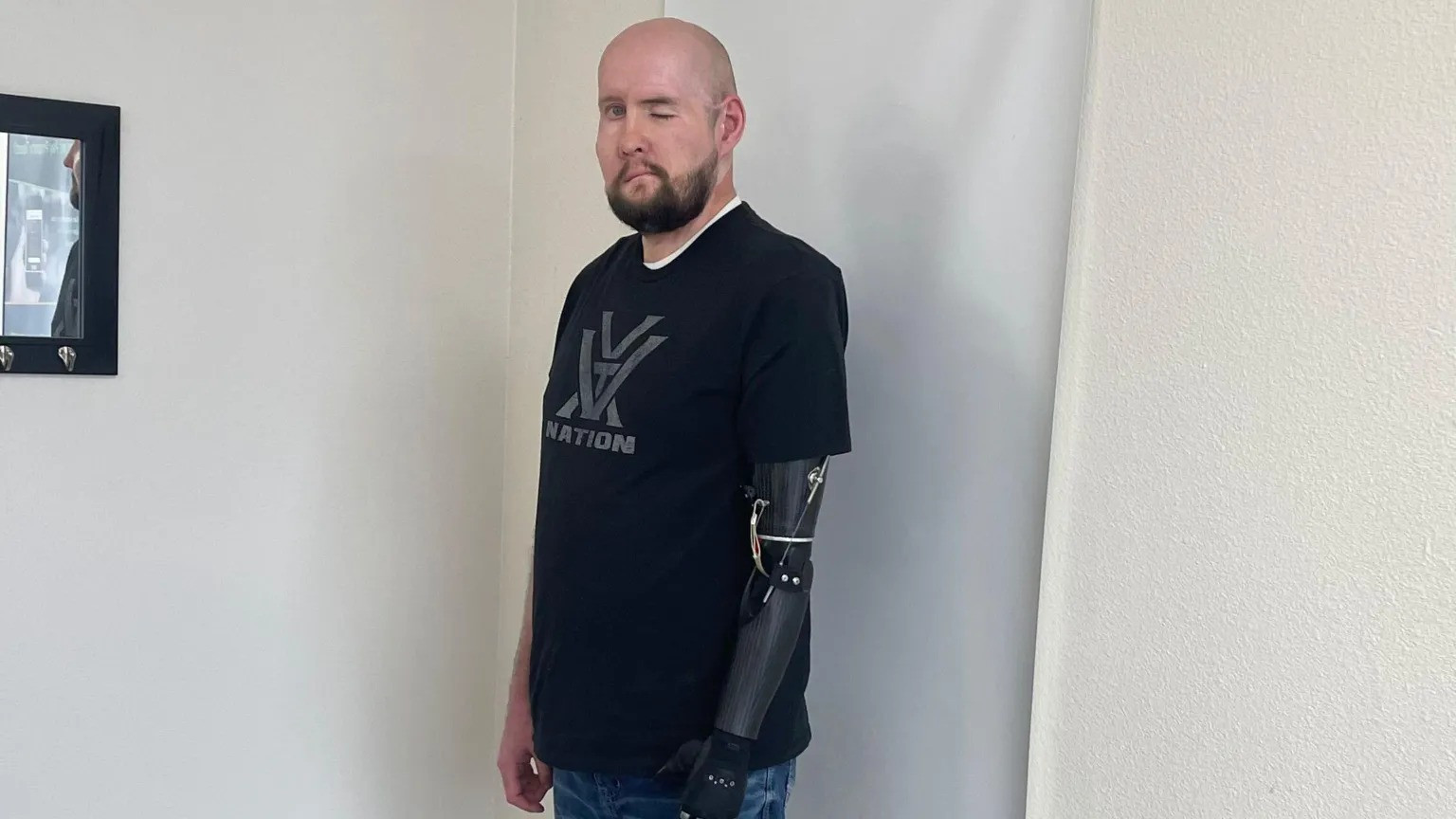 aron james, transplant