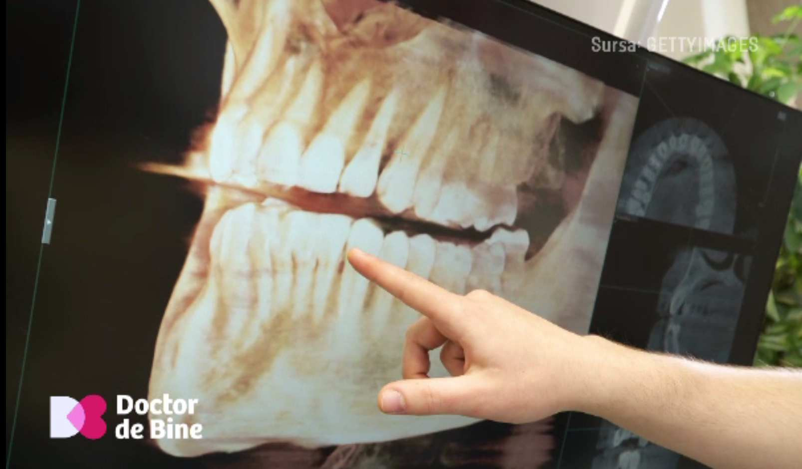 De ce se recomandă extracția măselelor de minte, chiar dacă nu s-au cariat. „Tind să dispară în evoluția noastră”