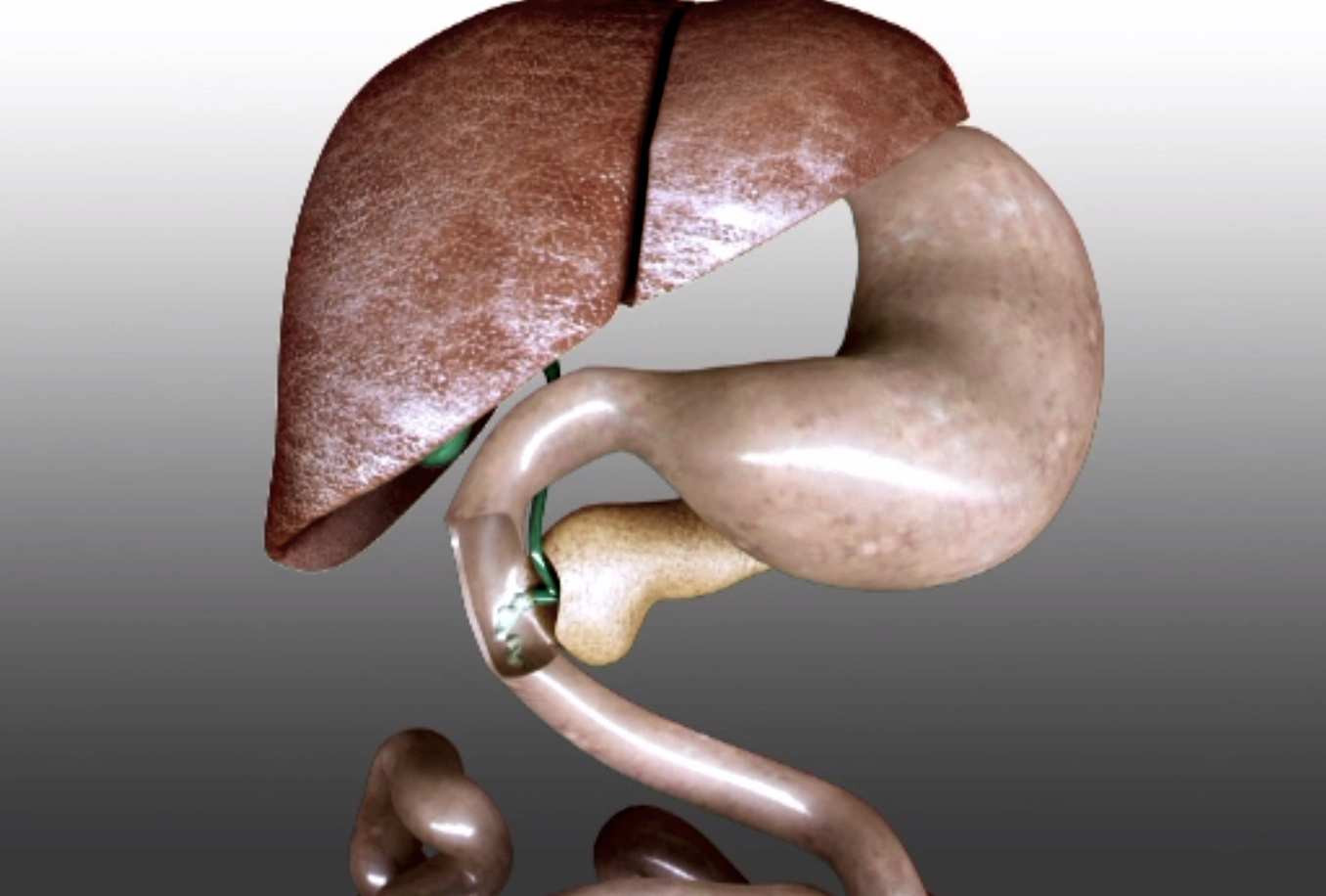 Boala ficatului gras poate duce chiar la transplant hepatic. Nu există medicamente care să o trateze