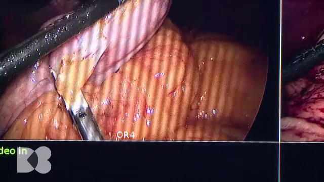 De ce este grăsimea viscerală extrem de periculoasă. Ce „minuni” se produc în corp când pacientul slăbește