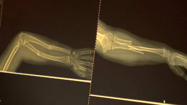 Fracturile grave cu care s-au ales zeci de copii în urma „Superman Challenge”, de pe TikTok. „Se vindecă într-un an de zile”