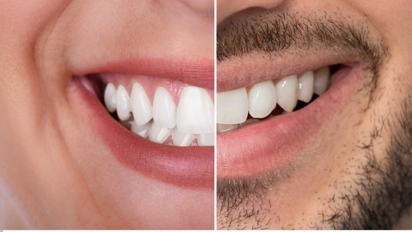 (P) Diferentele dintre sănătatea dentară la bărbați și femei: statistici și sfaturi