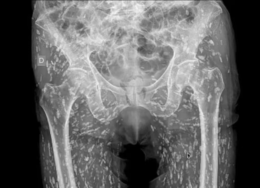 O radiografie a evidențiat paraziții care se înmulțeau în corpul unui bărbat după o greșeală comună făcută în bucătărie