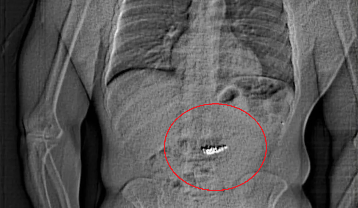 Un bărbat a înghițit cercei furați dintr-un magazin, în valoare de peste 700.000 de euro, înainte ca poliția să-l prindă