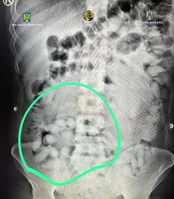 Un bărbat din Brazilia a fost prins pe Aeroportul Otopeni cu pachete de cocaină ascunse în stomac. FOTO