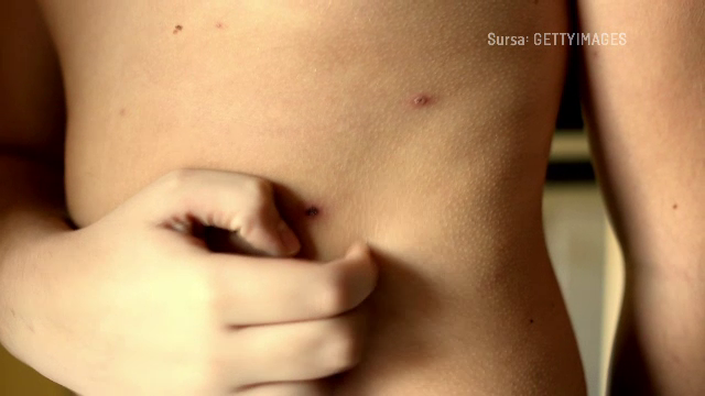 Antivaccinismul a readus în SUA o boală fatală care fusese eradicată. Doi copii au murit, dar Trump bagatelizează situația