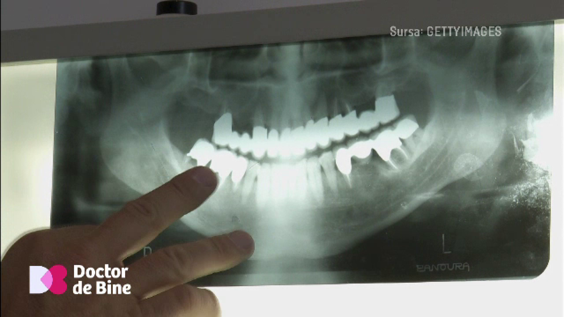 Cum afectează fumatul sănătatea dentară: Dinți pierduți pe nesimțite