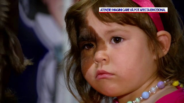 Povestea emoționantă a unei fetițe din SUA, născută cu o pată rară pe față, care și-a întâlnit eroul în viața reală