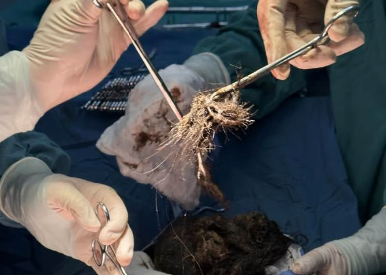 O fetiță și-a mestecat și m&acirc;ncat părul