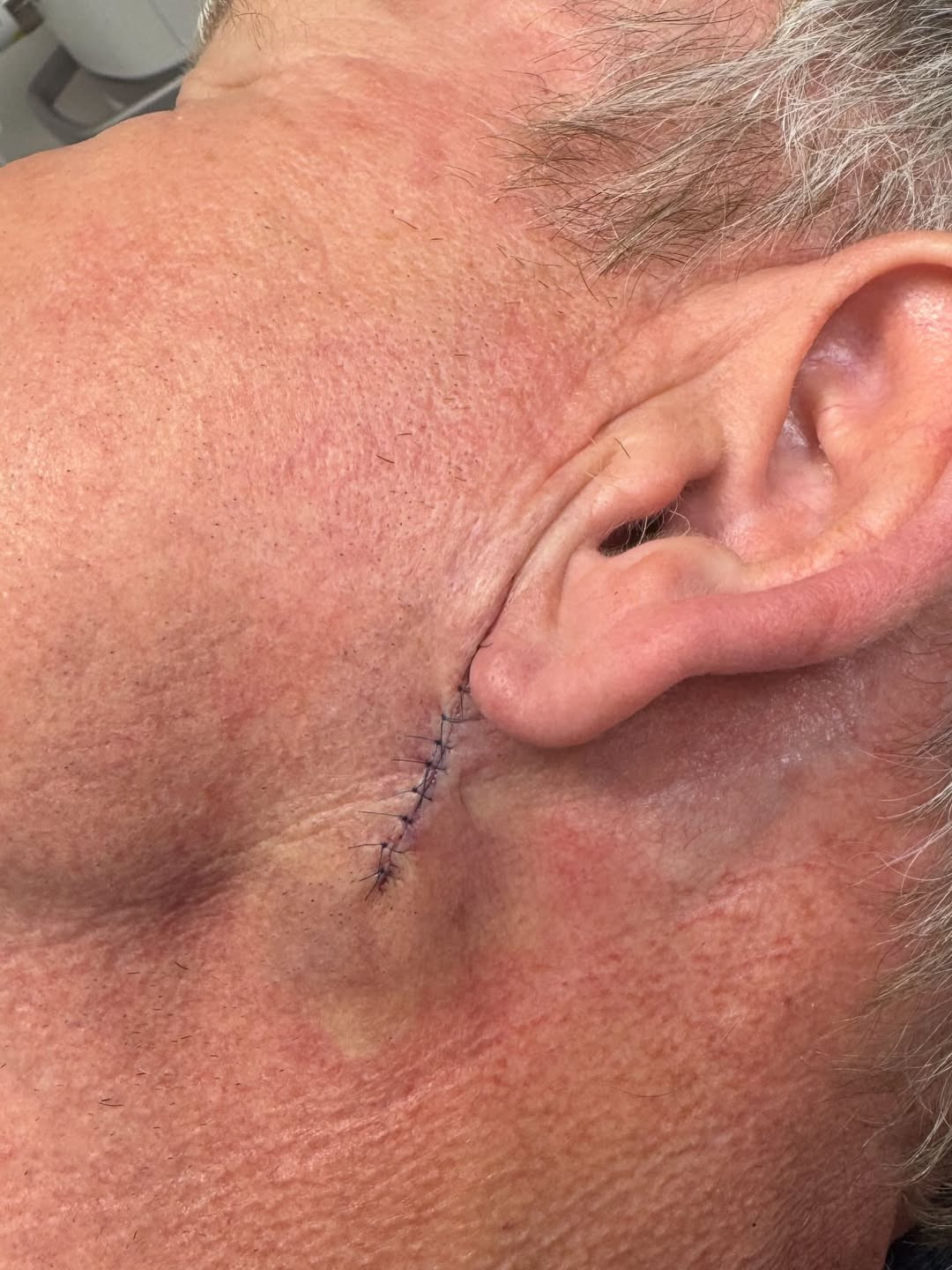 Gordon Ramsay a fost operat pentru cancer de piele. „Vă rog să nu uitaţi să vă daţi cu cremă de protecţie solară”