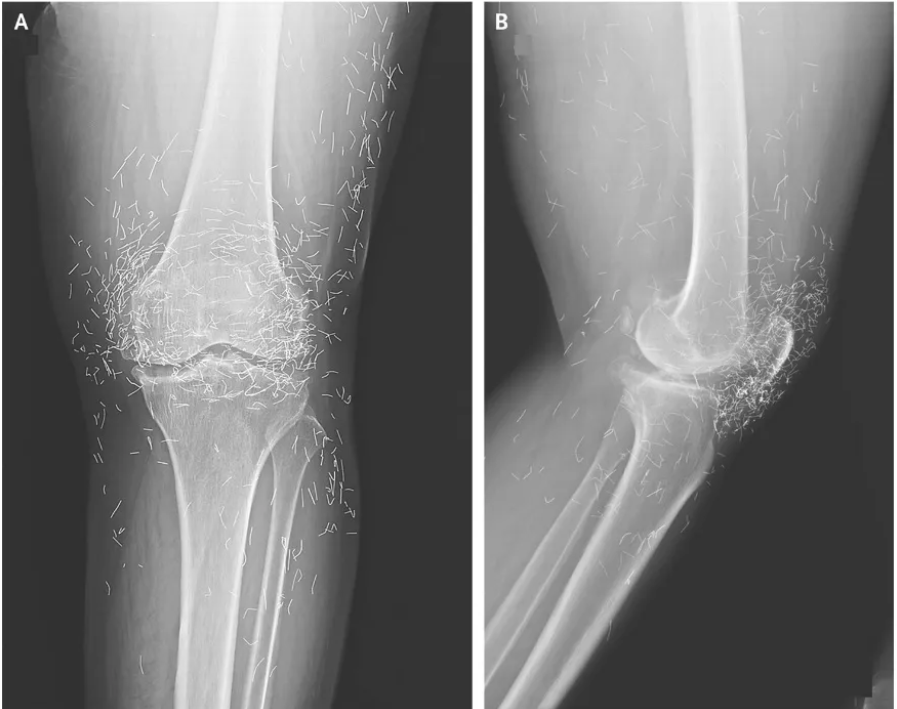 radiografie fire aur