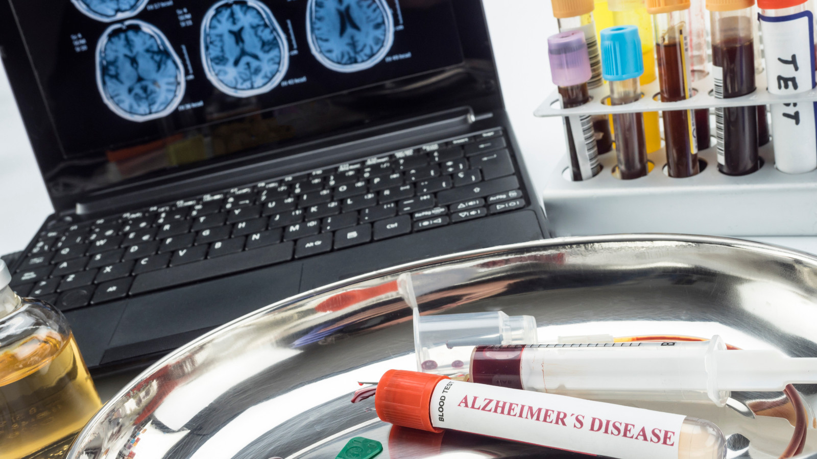 Un nou test de sânge ar putea revoluționa diagnosticarea Alzheimer. Studiul implică peste 1.000 de pacienți