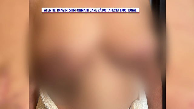 O femeie din Satu Mare spune că a fost mutilată după o operație la sâni. Medicul e acuzat și că a mințit la internare