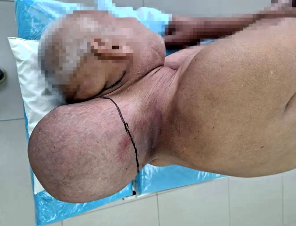 Un bărbat din Rusia cu o tumoare gigant a fost operat cu succes. Era ca și cum ar fi avut al doilea cap