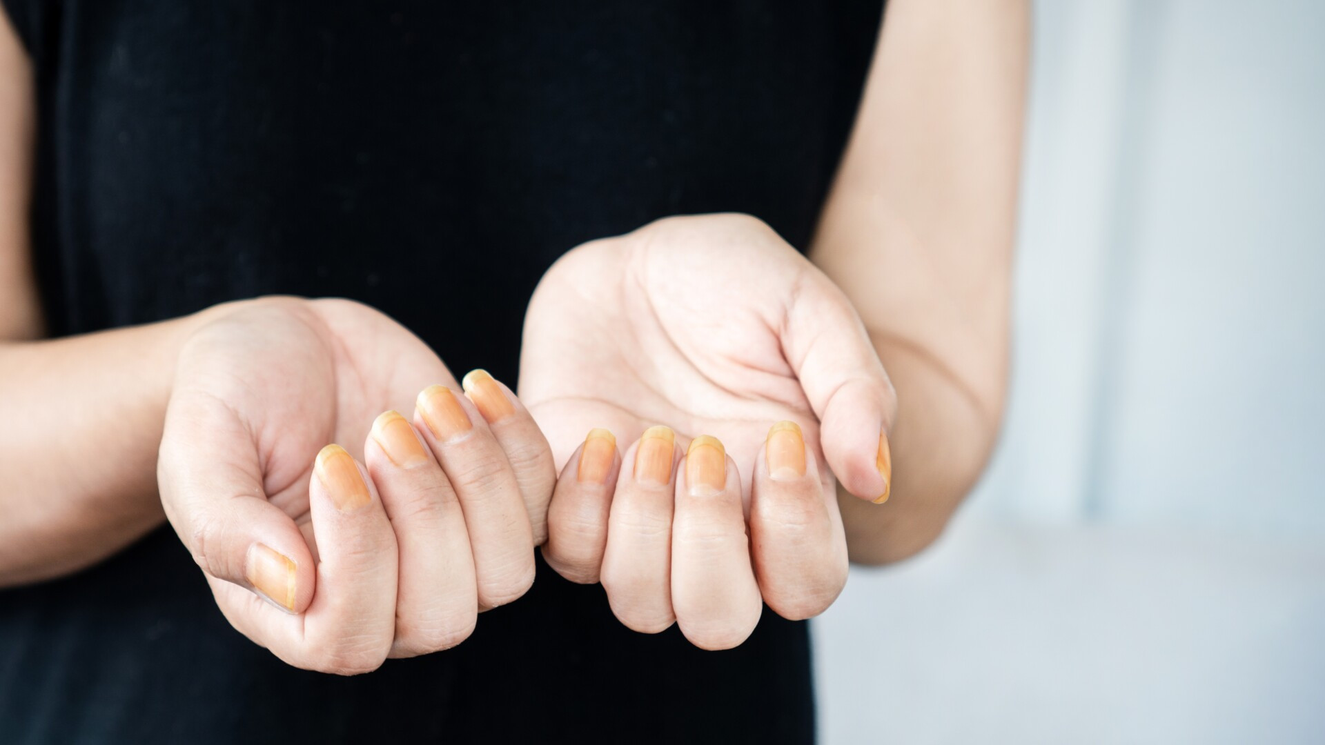 Dieta extremă care duce la îngălbenirea unghiilor și putrezirea dinților. O adeptă de 27 de ani, găsită moartă într-un hotel