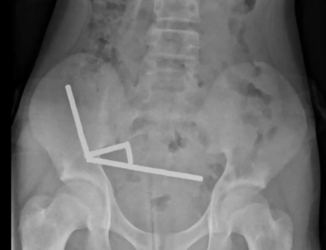 Un băiat de 13 ani a fost operat de urgență după ce a înghițit peste 100 de magneți. Ce le-a dezvăluit medicilor. FOTO