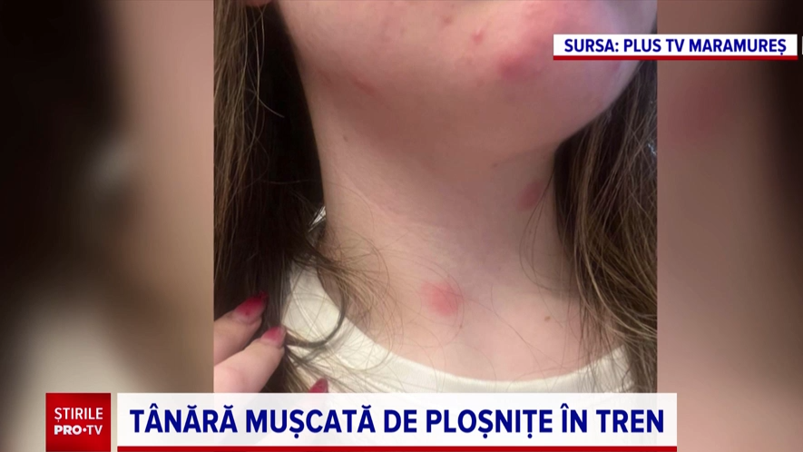 Incident revoltător într-un vagon de tren. O tânără a avut parte de o călătorie de coșmar, după ce a fost mușcată de ploșnițe
