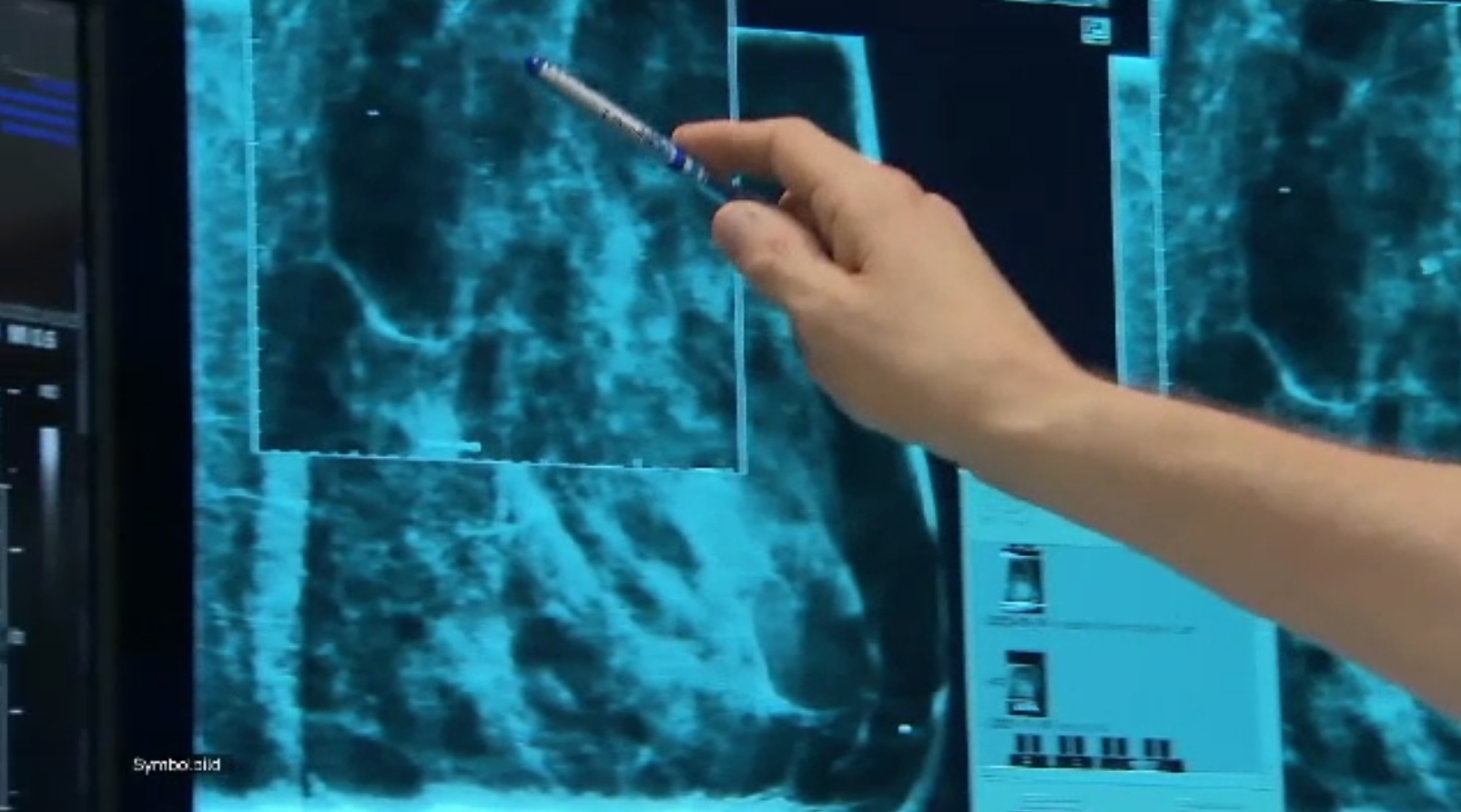 Eroare șocantă în Germania: un medic a diagnosticat greșit 34 de paciente cu cancer mamar, trimițându-le la tratamente