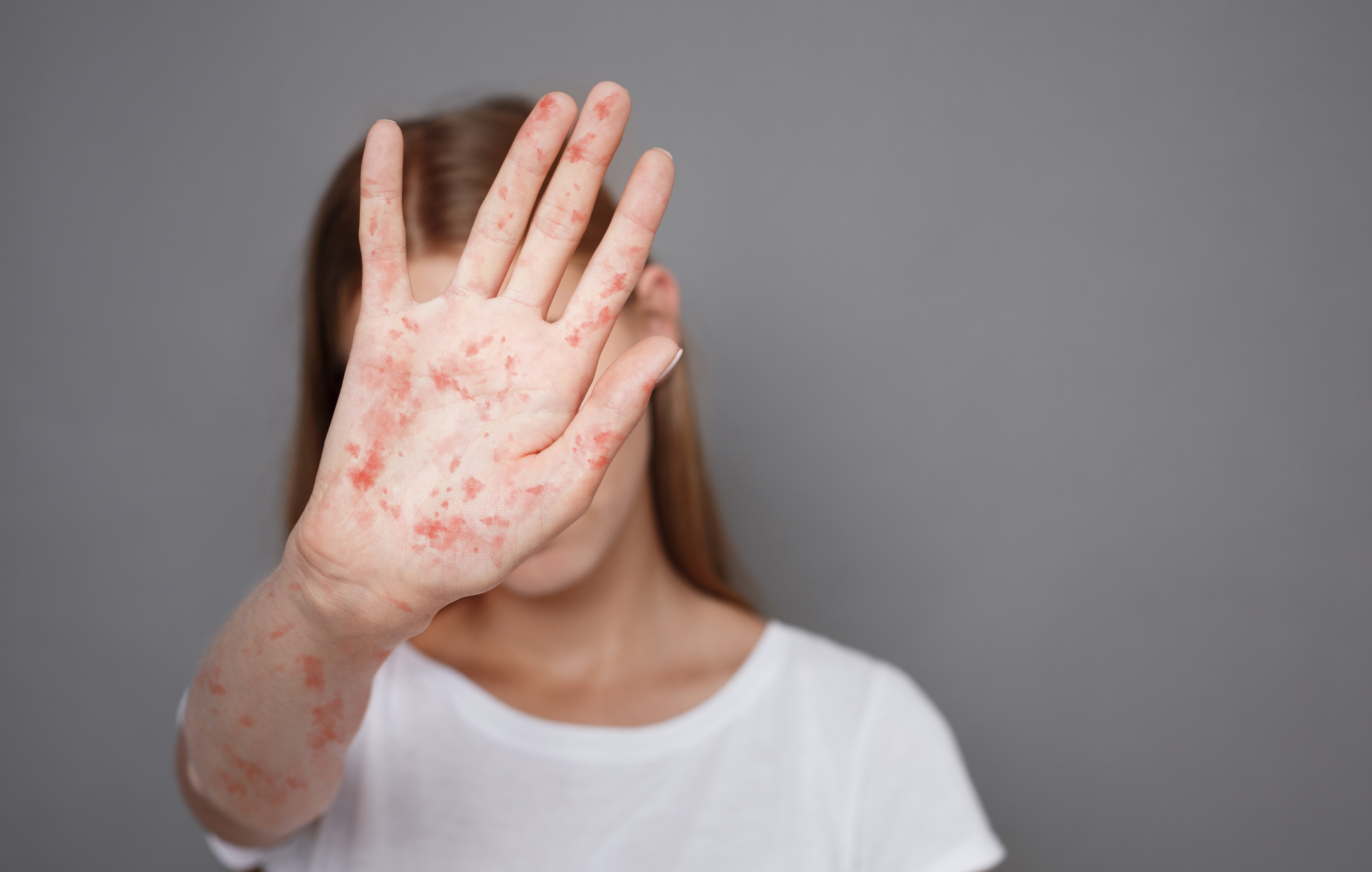 Reapariția rujeolei în Spania. Experții atribuie creșterea cazurilor migranților nevaccinați din Maroc și România