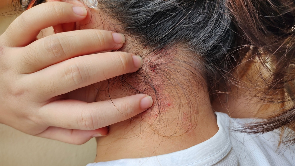 Încă un stat european a confirmat un caz de lepră. Guvernul pregătește reguli mai stricte