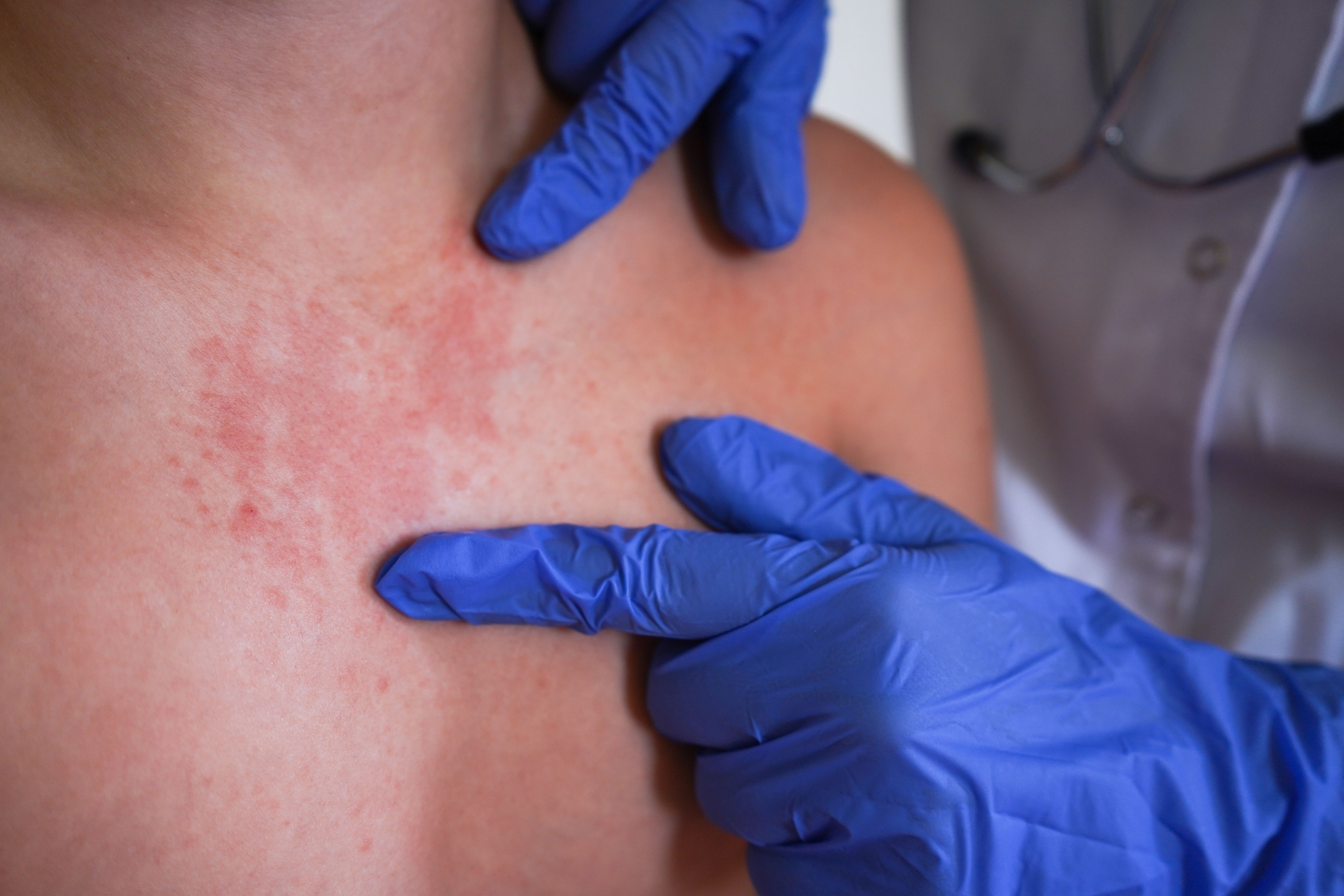 În SUA, epidemia de rujeolă continuă să facă ravagii în sudul ţării, pe fondul neîncrederii crescânde faţă de vaccinuri