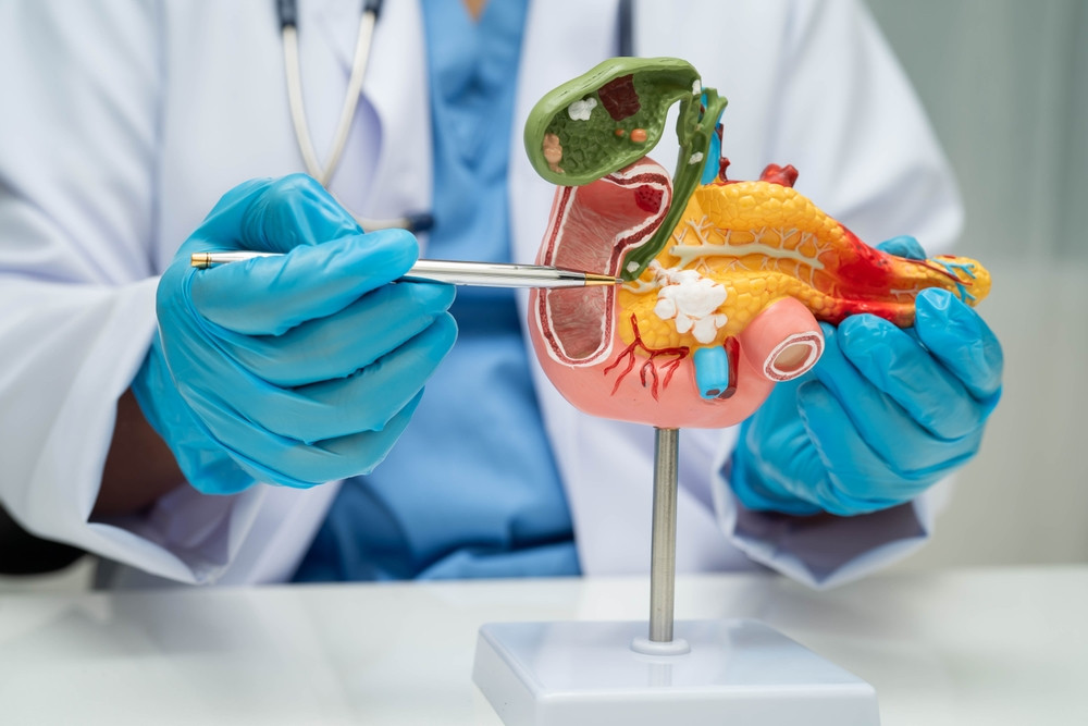 Studiu: O terapie care combină trei medicamente elimină cancerul pancreatic şi previne reapariţia acestuia