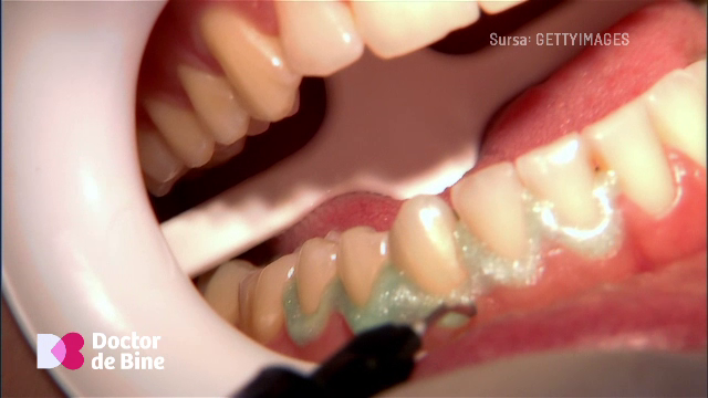 Detartrajul la fiecare 6 luni, esențial pentru sănătatea dinților și gingiilor. Când este indicată albirea dentară