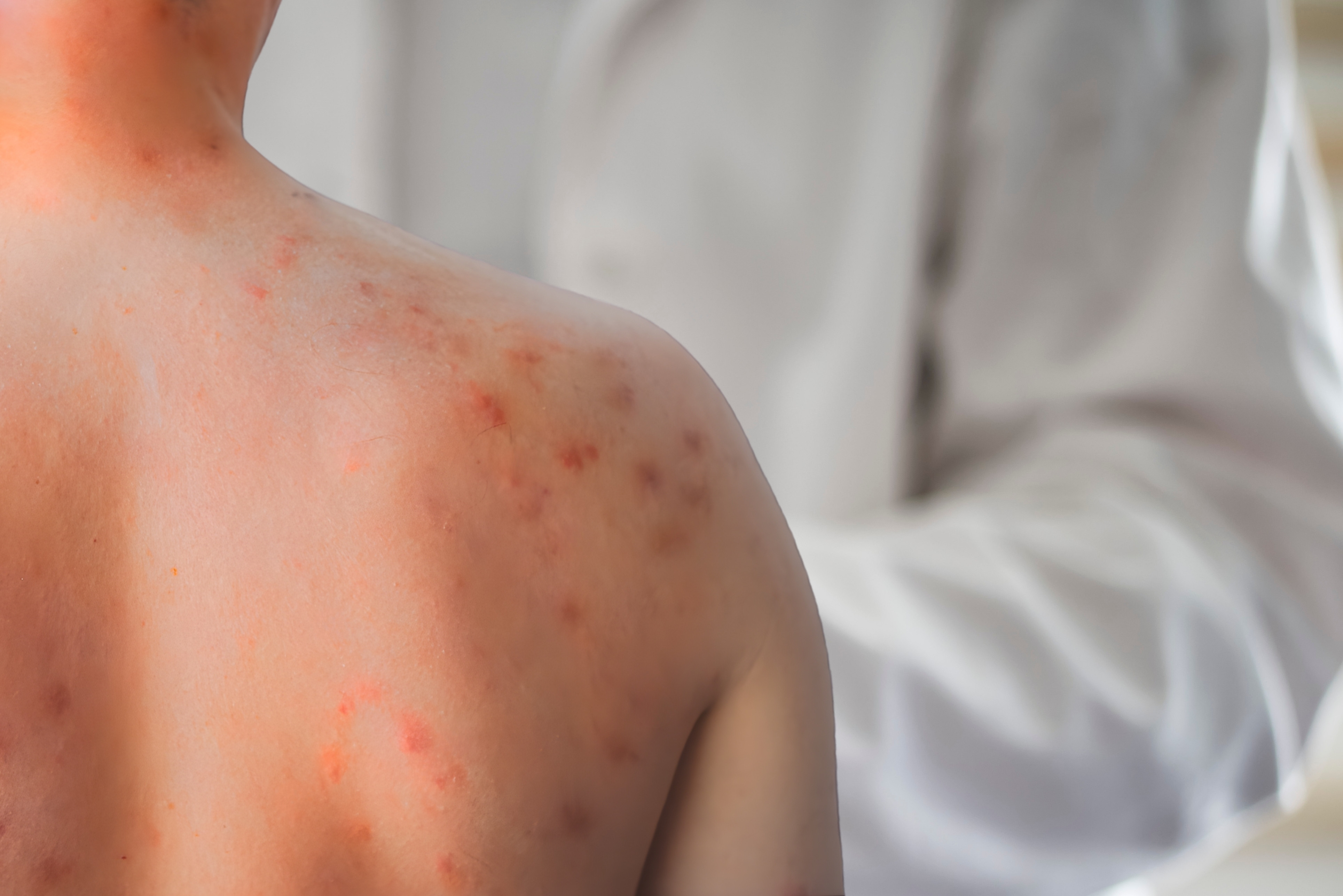 Studiu: Cercetătorii au identificat anticorpi umani care pot preveni și trata infecția cu rujeolă