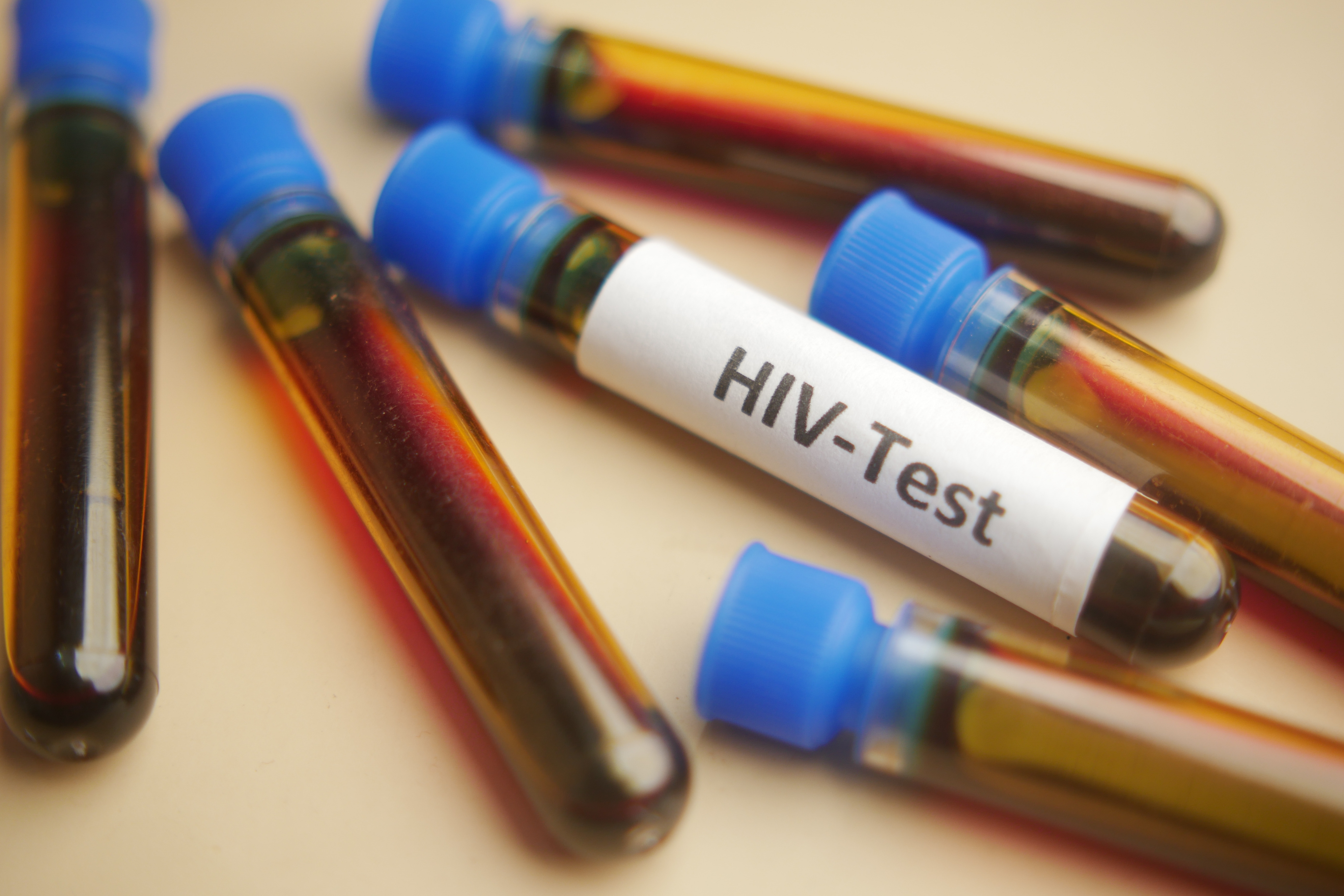 Studiu: O singură sesiune de terapie celulară poate ţine sub control infecţia cu HIV. Cum acționează