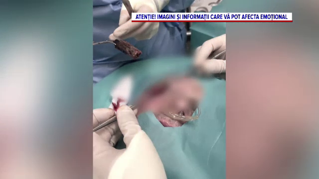 „Când a văzut, a rămas uimit”. Bucăți de lemn de 3 cm, scoase din fața unui pacient după ce a fost cusut de un ginecolog