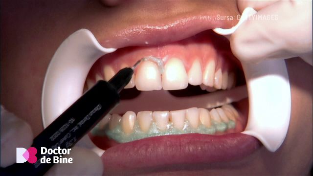 Fumatul ascunde parodontoza: gingiile nu sângerează, iar boala evoluează în tăcere. Cum pierzi dinții fără să știi