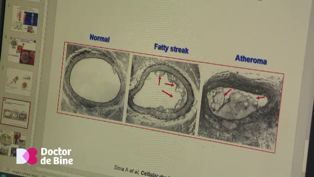 Ficatul gras crește riscul infarctului și al accidentului vascular cerebral. Ce efect are colesterolul LDL