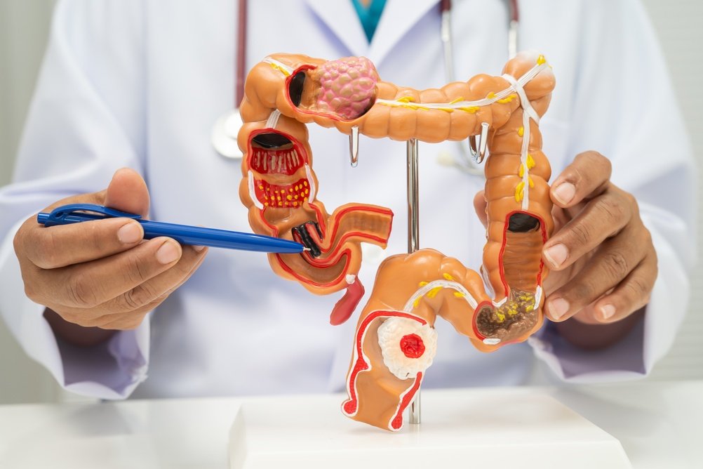 Persoanele născute după 1990 sunt de 5 ori mai expuse cancerului de colon. Explicațiile medicilor
