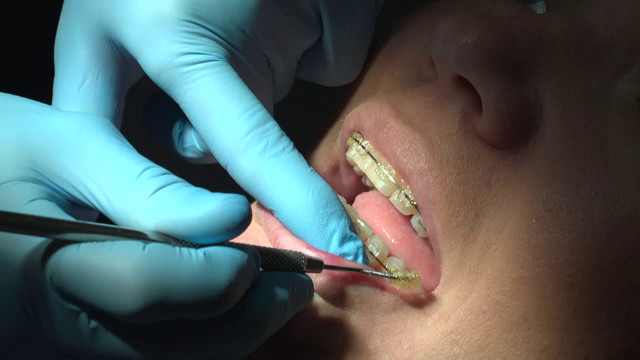 Aparatele dentare false, noul trend de pe TikTok. Medicii avertizează asupra riscurilor pentru dinți