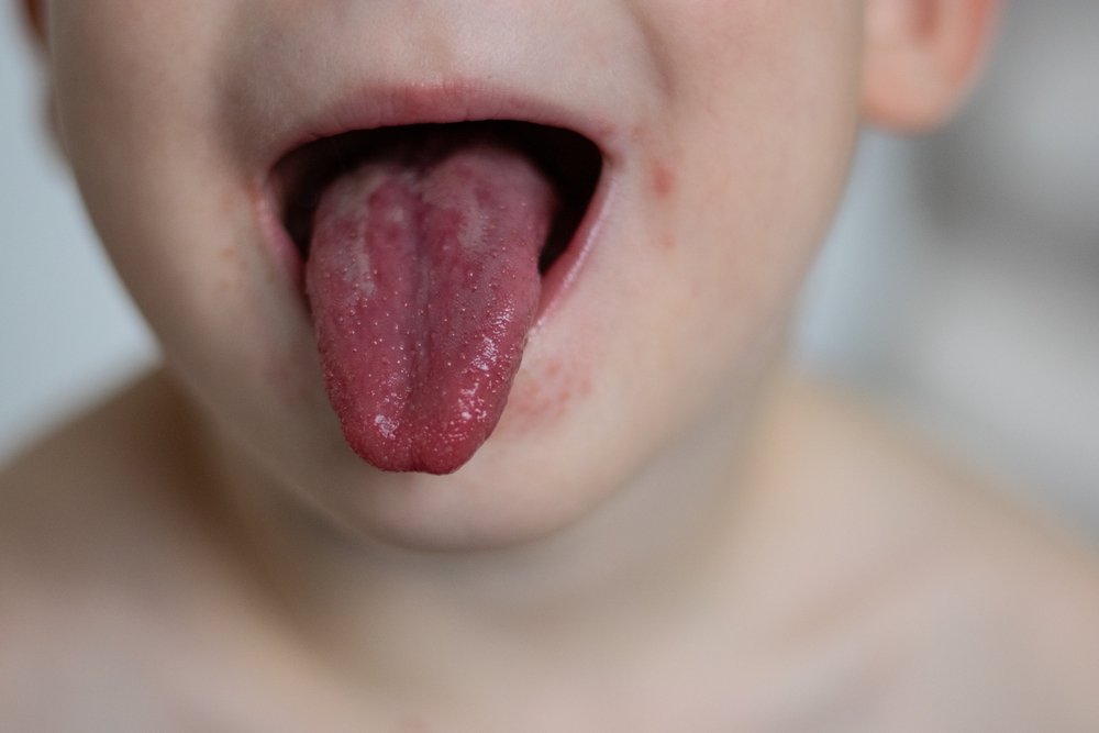 Scarlatina la copii. Primele semne, cum arată erupția și cât timp este contagioasă