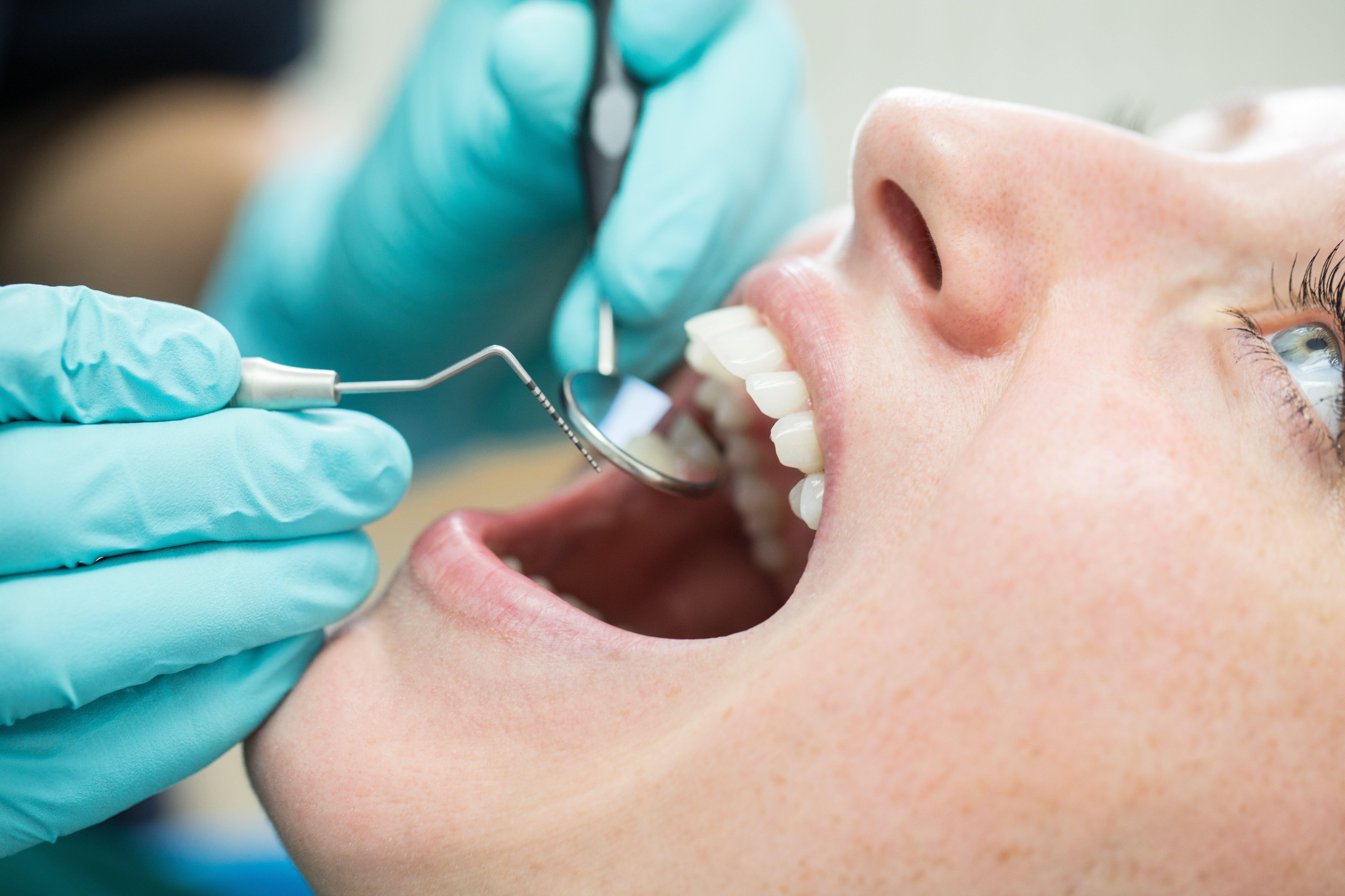 Igienizarea dentară, recomandată la fiecare 6 luni. Când se poate face albirea dinților și de ce nu funcționează pe coroane și fațete
