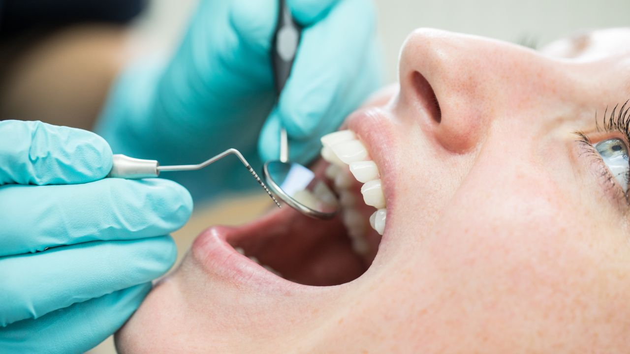 Igienizarea dentară și albirea dinților: când și de ce nu funcționează pe coroane și fațete